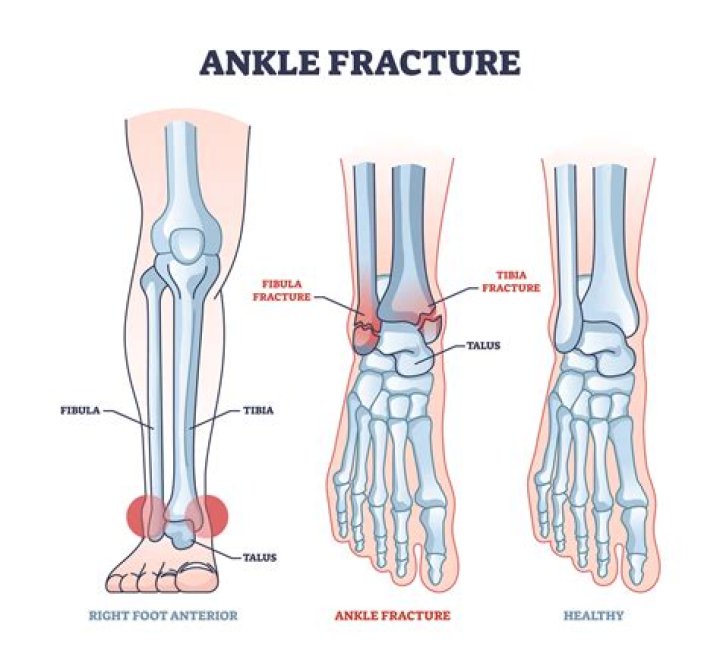 Does ice help a fractured foot?