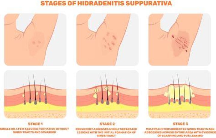 When does hidradenitis suppurativa stop?